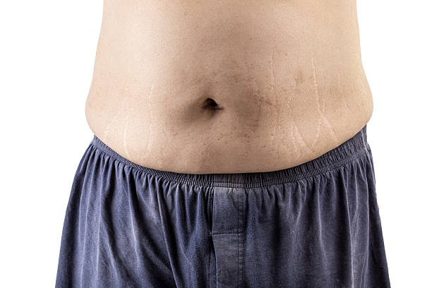 Person showing their belly with visible stretch marks