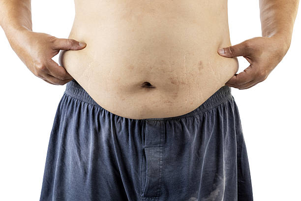 istock Person pinching belly fat with both hands, image highlights in folds, emphasizing realistic portrayal of human physique 2245544125