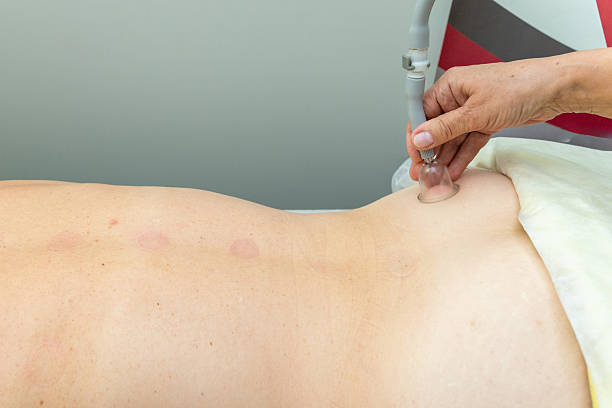 istock A close-up shot of a person's back while undergoing a vacuum therapy treatment 2245659223