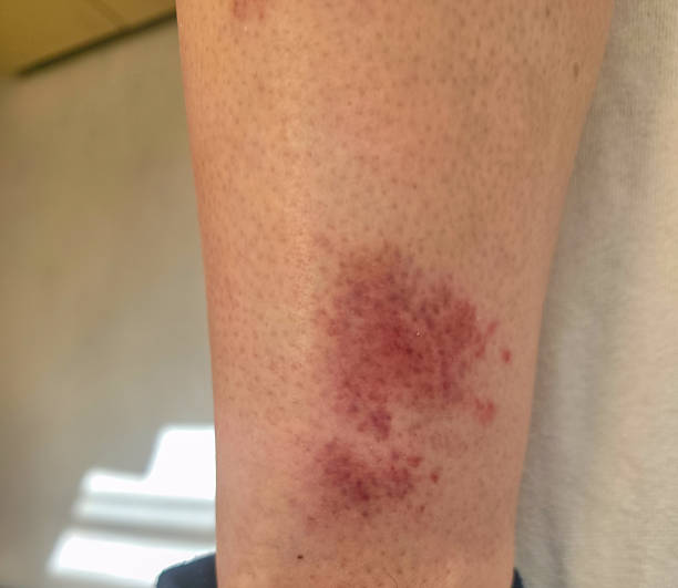 istock skin rash due to vasculitis 2246064221