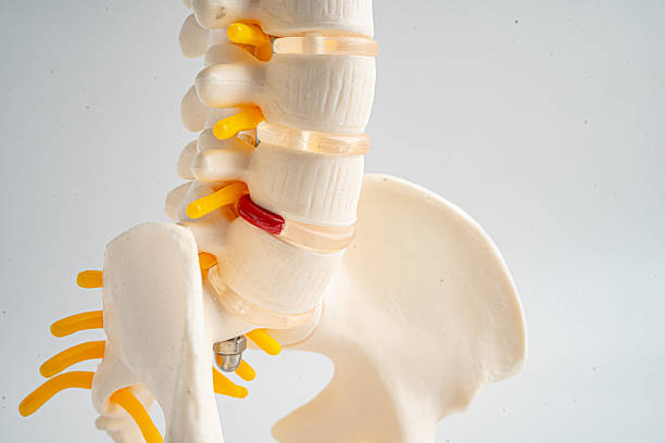 istock Lumbar spine displaced herniated disc fragment, spinal nerve and bone. Model for treatment medical in the orthopedic department. 2246116563