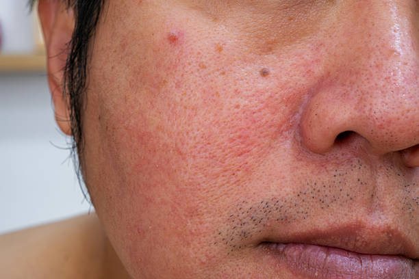 istock Facial redness, acne, and blemishes highlight irritated skin. 2246125092