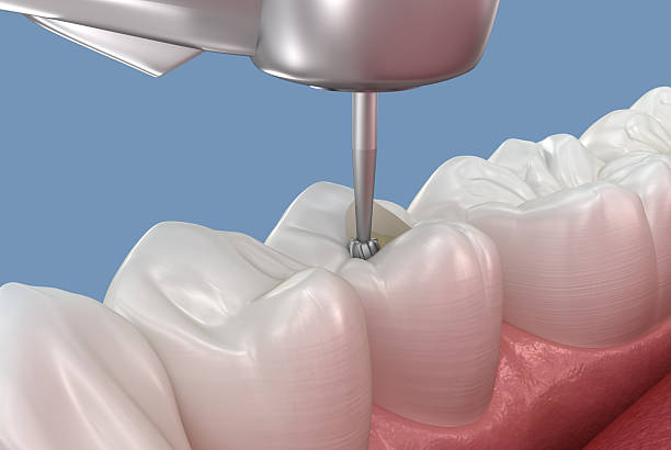 istock Making access to the root canal. Medically accurate tooth 3D illustration. 2246184660