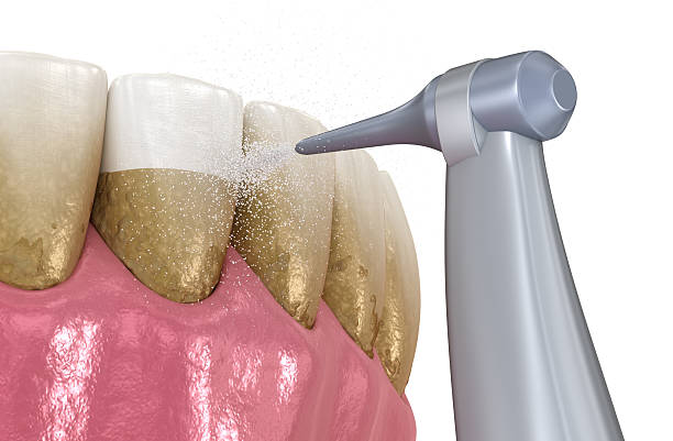 istock Oral hygiene: Air flow teeth cleaning process. Dental 3D illustration 2246184663