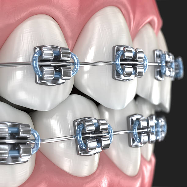 istock Metal braces on teeth, macro view. 3D illustration 2246184674