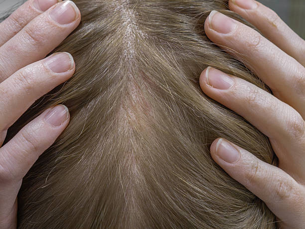 istock scalp diseases, dermatological problems, alopecia areata in women 2247083575