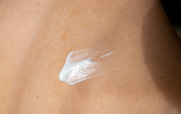 istock On woman's back skin smears cream after sun burn 2247540103