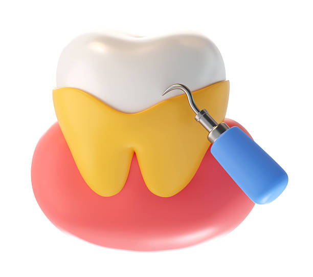 istock Dental Scaling Treatment 3D Icon Calculus Removal Procedure 2247765032