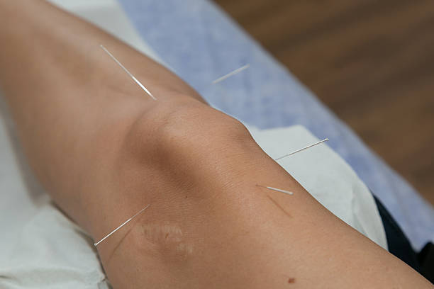 istock Bright skin illuminated by acupuncture points, Shimmering joint with fine needles and soothing surroundings 2247877527