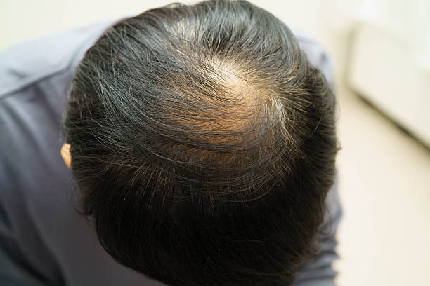istock Bald head in man, hair loss treatment health problem. 2247905863
