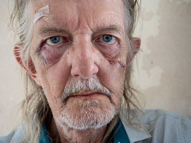 istock Elderly man with scarred and bruised face 2248261831