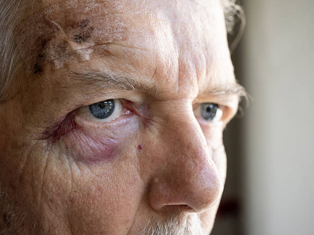 istock Elderly man with scarred and bruised face 2248261875