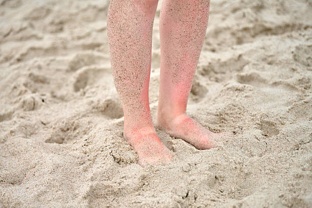 istock Sandy feet on beach with sunburnt ankles 2248383255