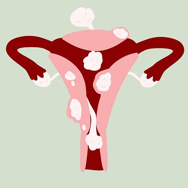 istock Female Reproductive System with Uterine Fibroid Illustration 2248480371