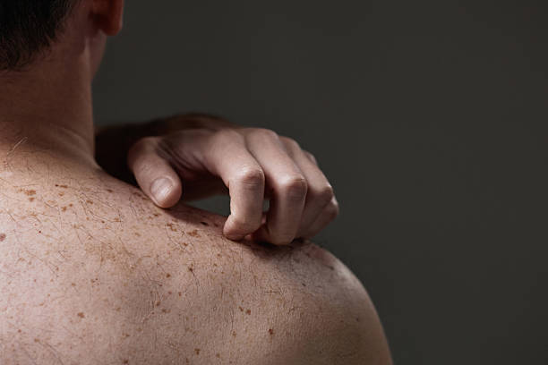 istock Middle Aged Caucasian Man Scratching Back Experiencing Skin Irritation 2248826546