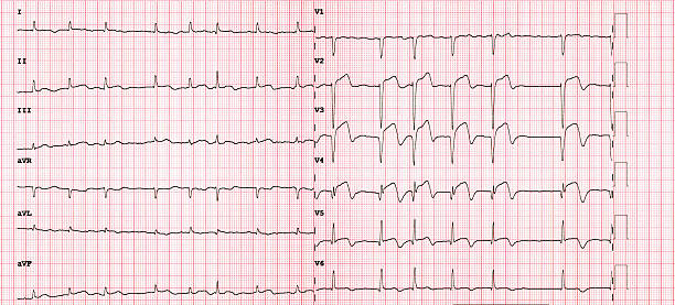 istock Acute Anterior Myocardial Infarction ECG with Ventricular Tachycardia Complication STEMI Medical Emergency Cardiology Diagnostic 2248884638