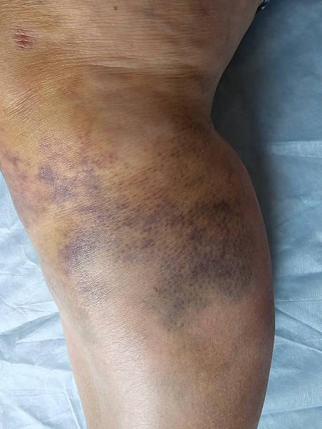 istock Bruises and discoloration on the knee after a fall or injury 2248974176