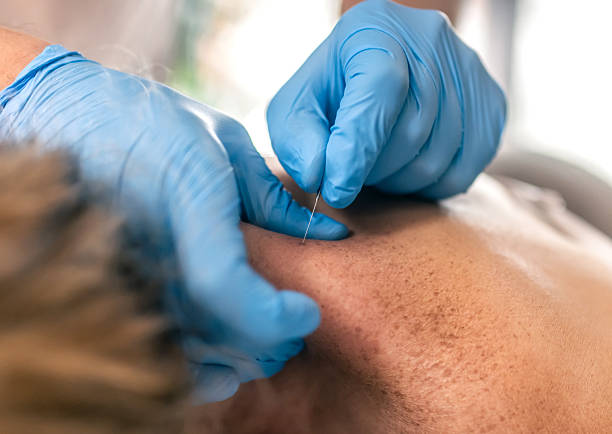 istock physiotherapist performing dry needling therapy, medical acupunture 2249134515