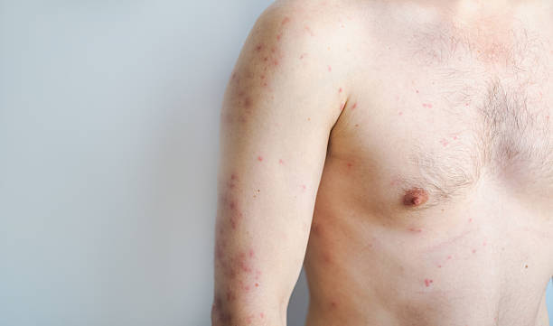 istock Man with sudden rash large blisters and redness on body typical hives outbreak caused by stress or food allergy 2249294887