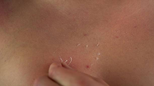istock Man rubbing peeling sunburned skin in close-up, 4K 2249426520