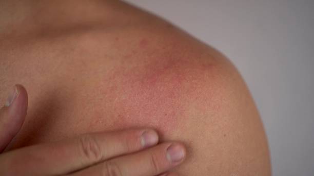 istock Bee sting on male shoulder in close up, 4K 2249427276