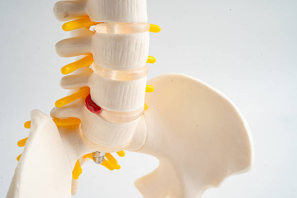 istock Lumbar spine displaced herniated disc fragment, spinal nerve and bone. Model for treatment medical in the orthopedic department. 2249672500