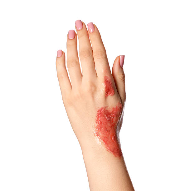 istock Woman with burned hand on white background, closeup 2250080082
