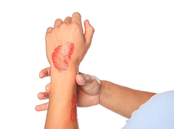 istock Man with burned hand on white background, closeup 2250080133
