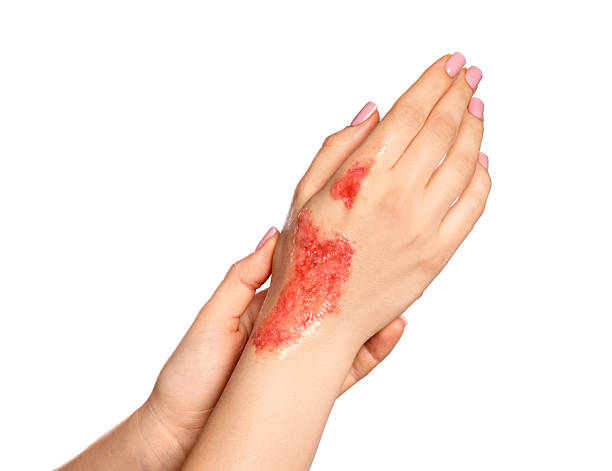 istock Woman with burned hand on white background, closeup 2250080235