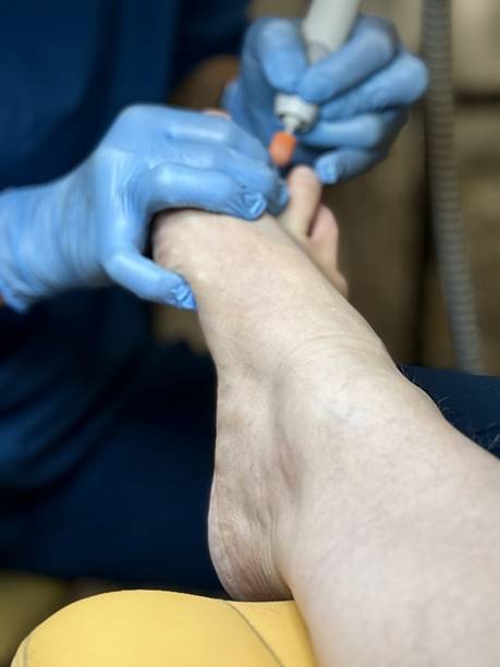 istock Hardware medical pedicure using a drill and nail files. A patient has a pedicure at a podiatrist. A dangerous fungal lesion of human toenails. Onychomycosis, treatment of nail fungus 2250333233