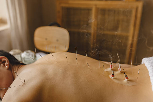 istock Relaxed female patient lying on treatment table having rest while her nude back being covered with acupuncture sterile needles and burning moxa. Unrecognizable woman undergoing moxibustion therapy 2250648614