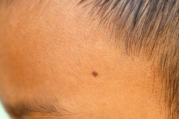 Close up of a black mole on a boy's scalp