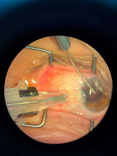 istock Cataract Surgery on Senior Patient. Phaco Handpiece 2251542069