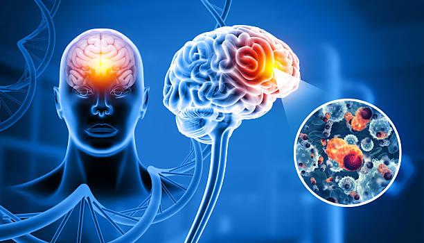 istock Cancer cells attacking a human brain. 3d illustration 2251966306