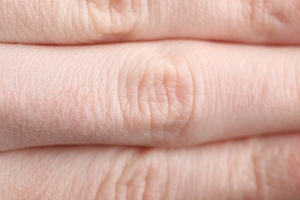 Texture of dry skin as background, closeup