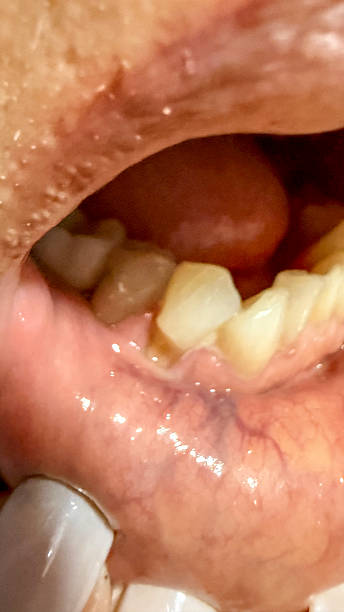 Senior Hispanic woman tooth decay
