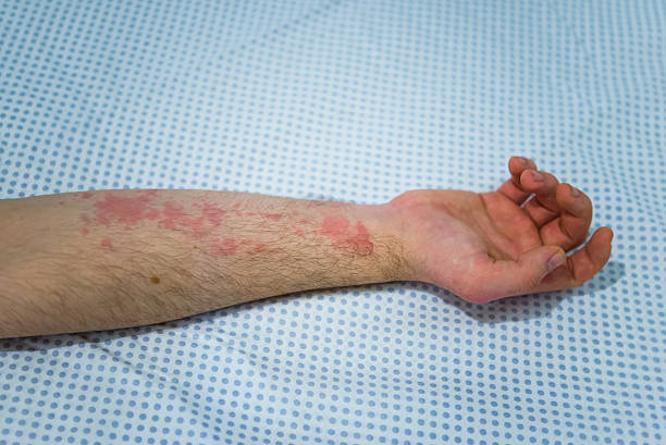 istock Allergic skin rash on hand from drug allergy 2252936297