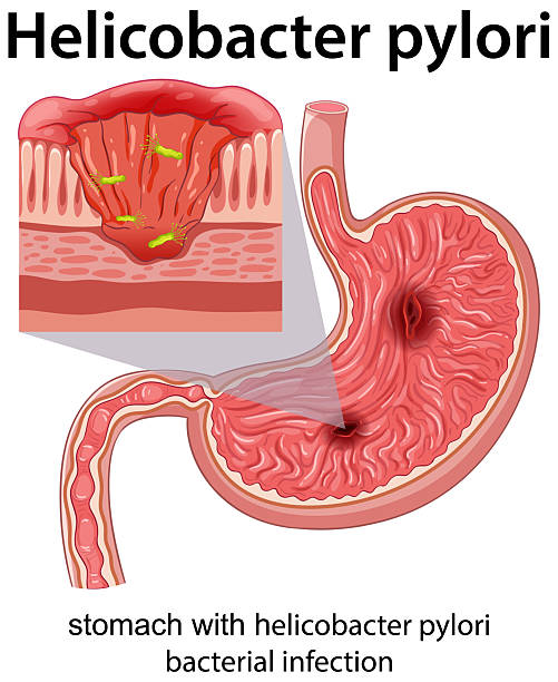 istock Stomach Cross-Section Showing Helicobacter Pylori Bacterial Infection 2253557550