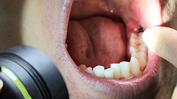 istock Inside the mouth after wisdom teeth extraction 2253761667