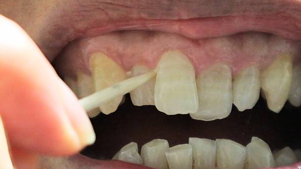 istock A person cleaning the gaps between their teeth with a toothpick 2253761963
