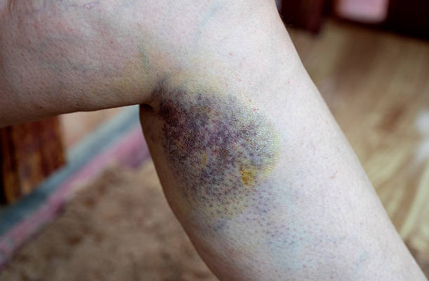 istock Bruises in the leg area after a minor fall, a visible discoloration and swelling indicate soft tissue damage recorded indoors in daylight. 2253808348