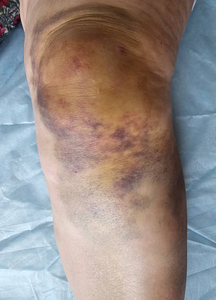 istock Severe bruising on the knee area after a fall on a hard surface outdoors 2253955775