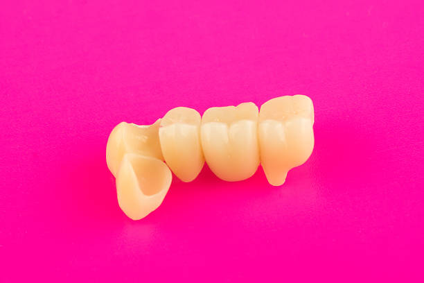 ceramic dental bridge for restoration of chewing and aesthetics