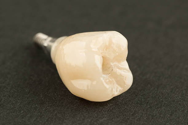 istock ceramic dental crown for fixation on a dental implant 2254063207