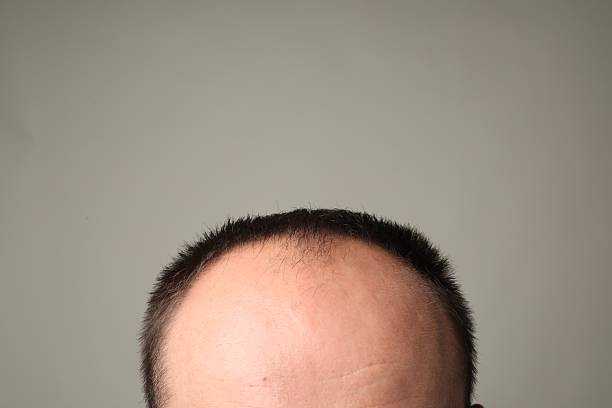 Baldness problem. Man with receding hairline on grey background, closeup
