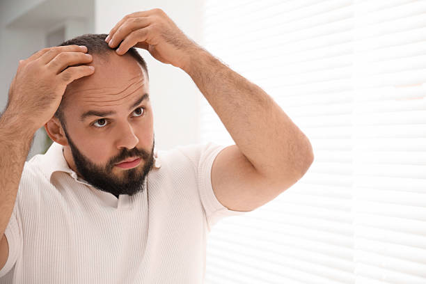 istock Baldness problem. Man with receding hairline near window at home. Space for text 2254107858