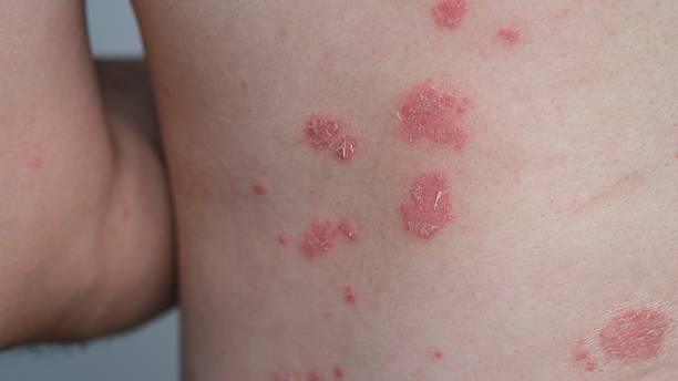 istock A man with his Psoriasis on his back. 2254112093