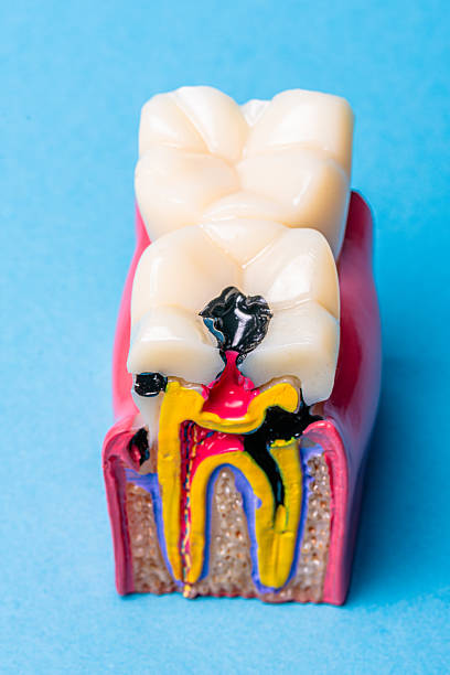 istock Dental model showing severe tooth decay and root canal 2254455685