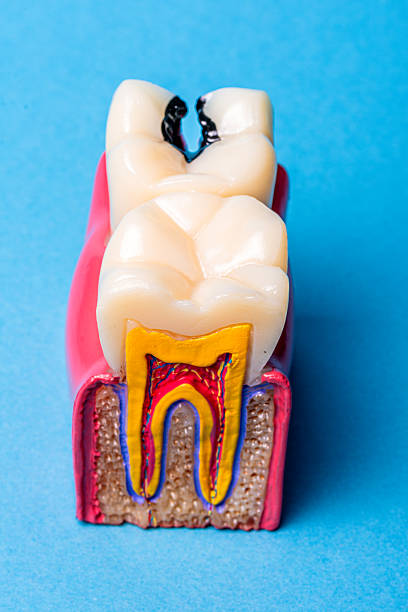 istock Dental disease model showing cavity and inner tooth 2254455693