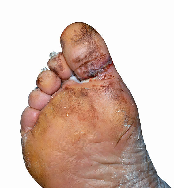 istock A large laceration between the big toe and the foot 2254656686